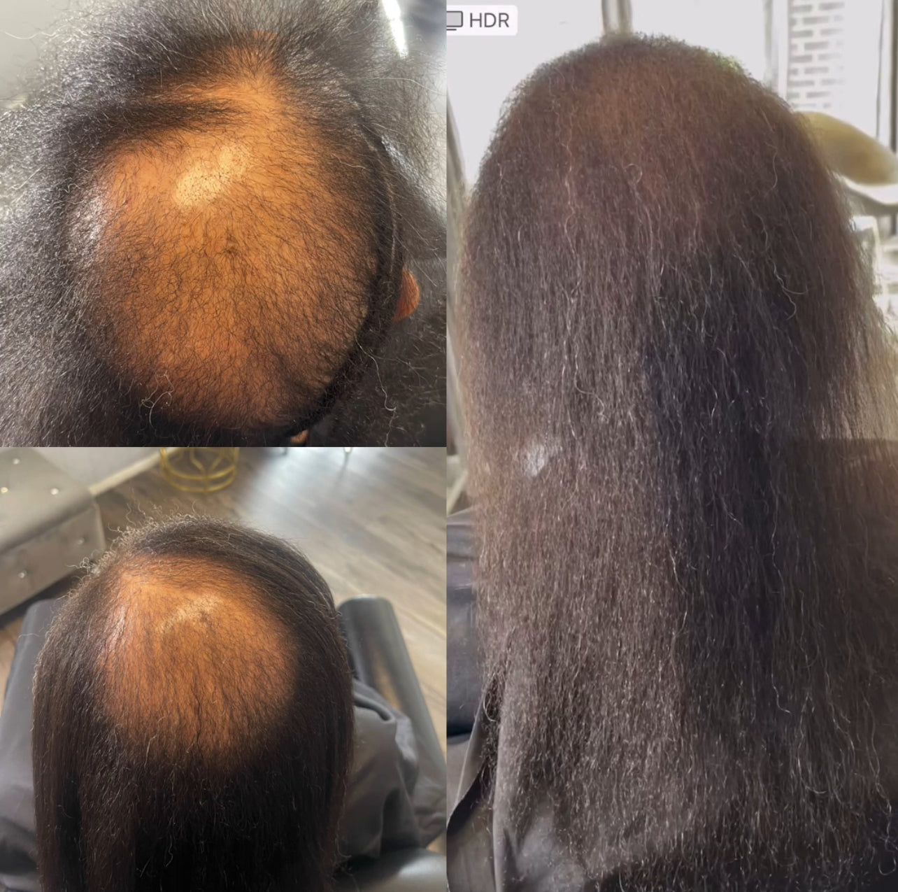 Load video: 1 Year results using Tresses Growth Oil